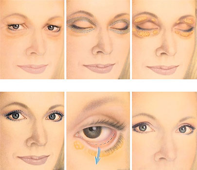 eyelid surgery tunisia